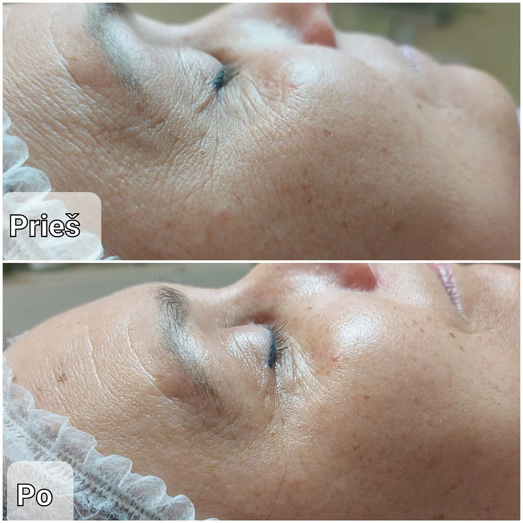 Kosmetologijos Paslaugos 17 Senėjimą lėtinanti, stangrinanti ir skaistinanti procedūra veidui Vilkaviškyje