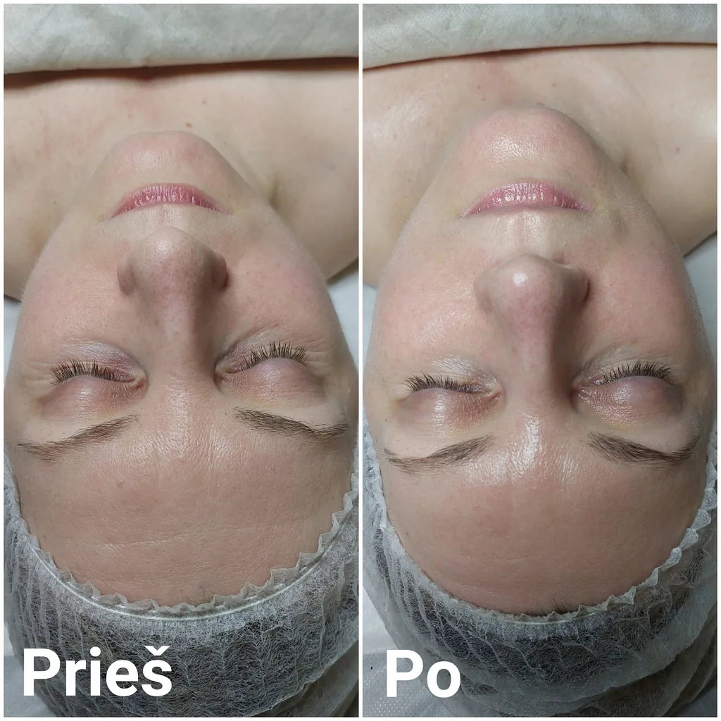 Kosmetologijos Paslaugos 10 Moteriai atliekama karboksi terapija veidui klinikoje Vilkaviškyje