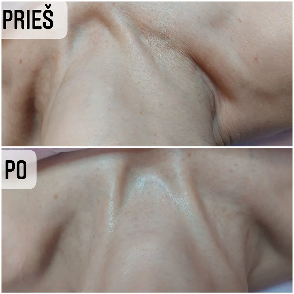 Kosmetologijos Paslaugos 18 Rezultatas po kaklo masažo Elegansuus salone