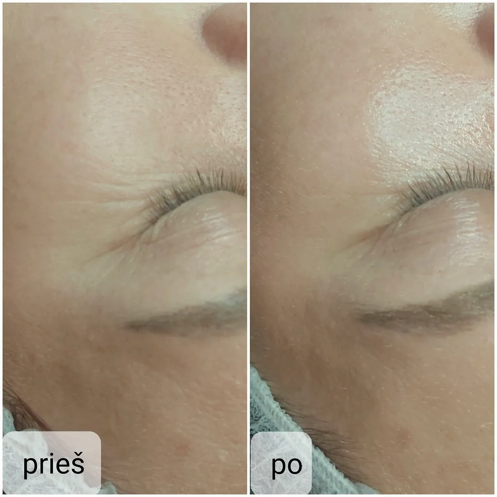 Kosmetologijos Paslaugos 8 Rūgštinės procedūros sausai ir riebiai odai Vilkaviškyje