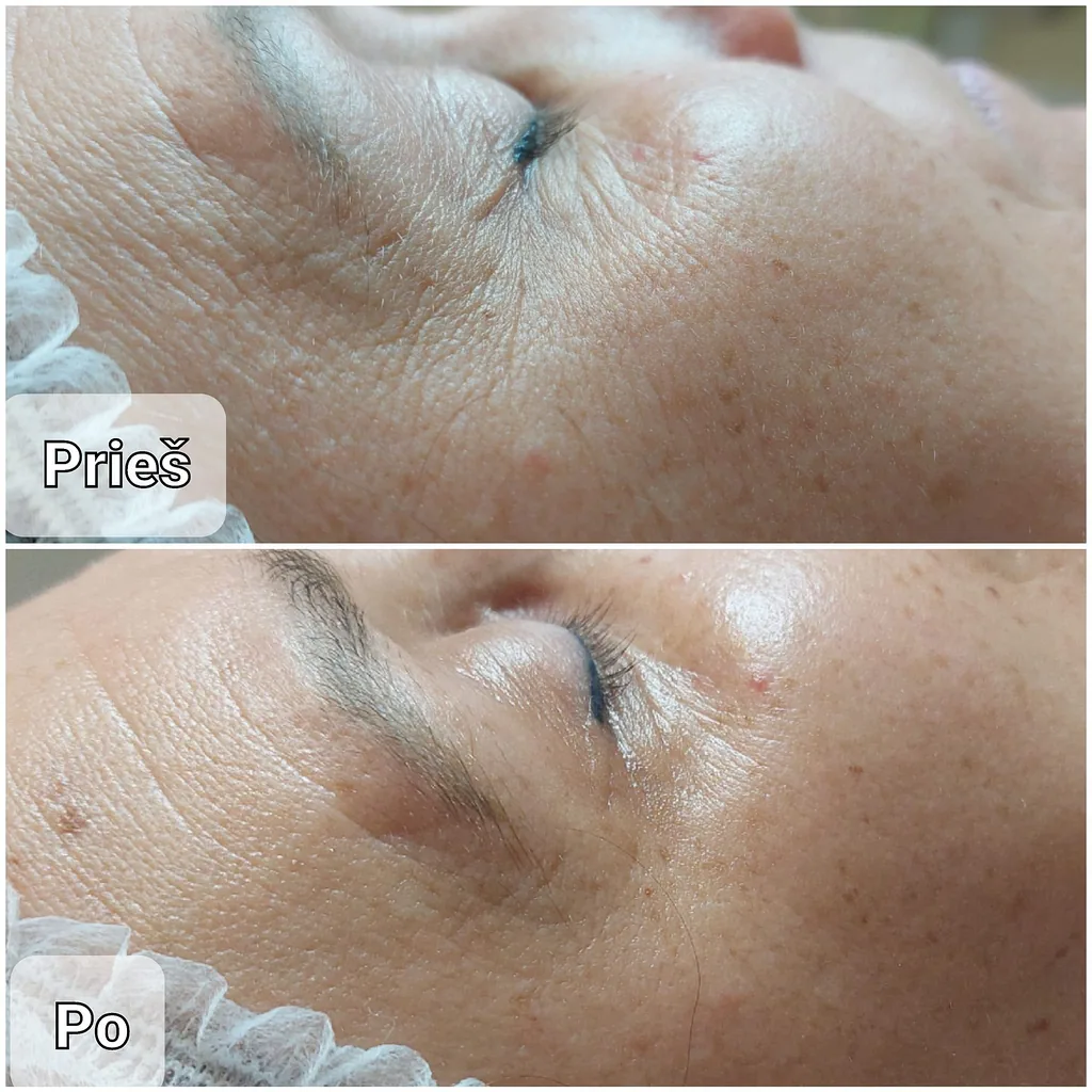 Kosmetologijos Paslaugos 14 Veido drėkinimo procedūros rezultatai prieš ir po procedūros
