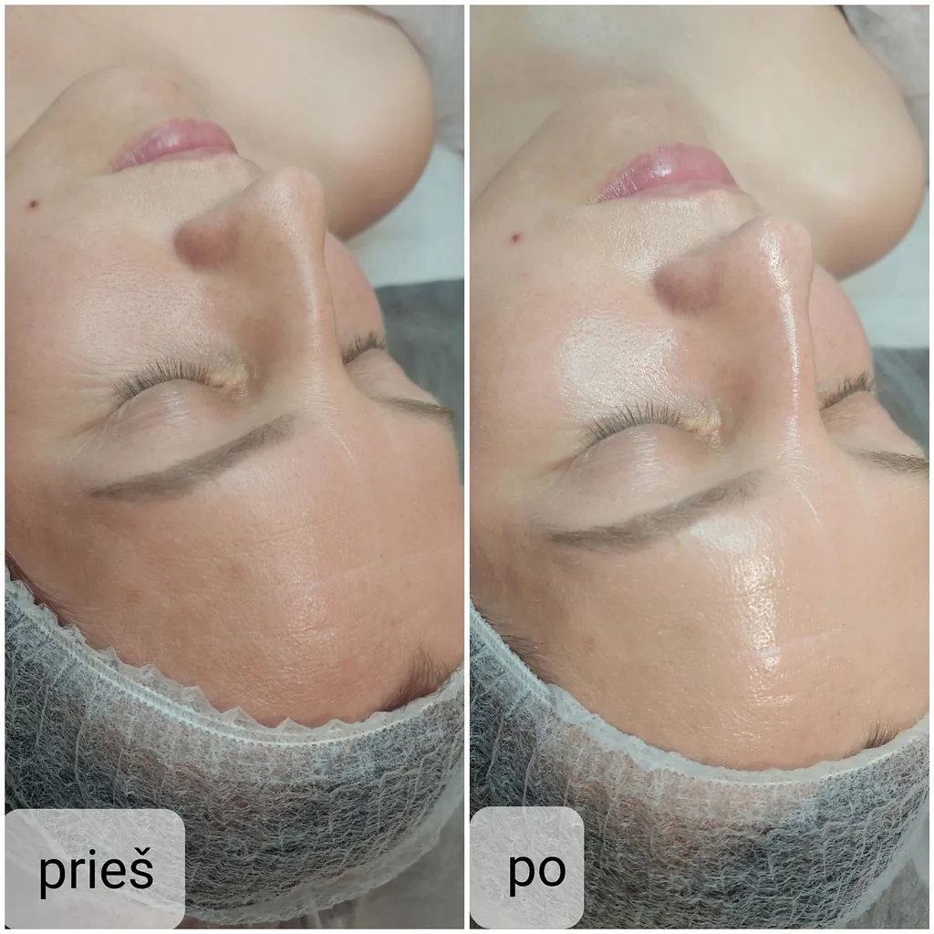 Kosmetologijos Paslaugos 13 Rezultatas po veido valymo ir skaistinimo procedūros