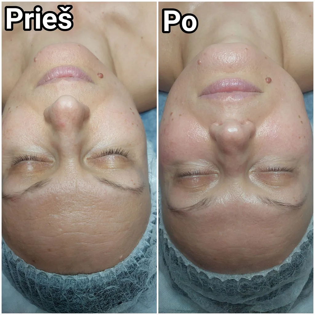 Kosmetologijos Paslaugos 6 Senėjimą lėtinanti procedūra Vilkaviškyje